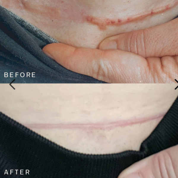 Scar Occlusion Patch™