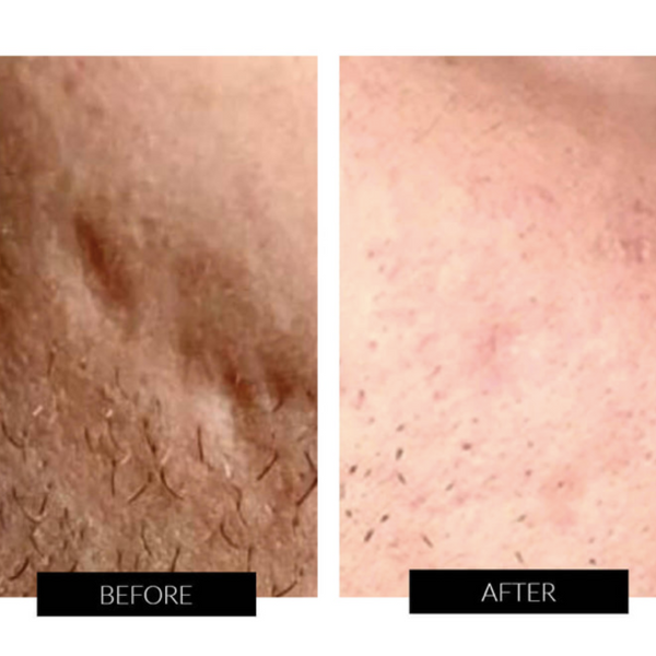 Layma Dermal The LYMA Laser