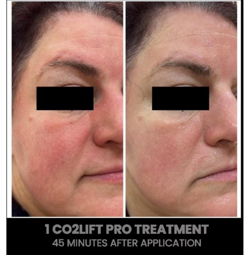 CO2Lift Pro Carboxy Gel Treatment