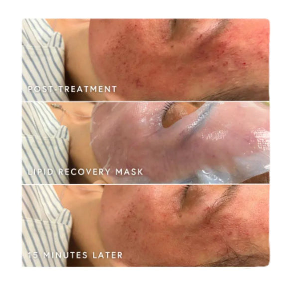 Lipid Recovery Face Mask - Single