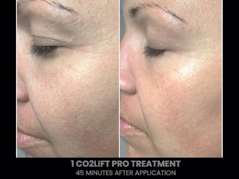 CO2Lift Pro Carboxy Gel Treatment